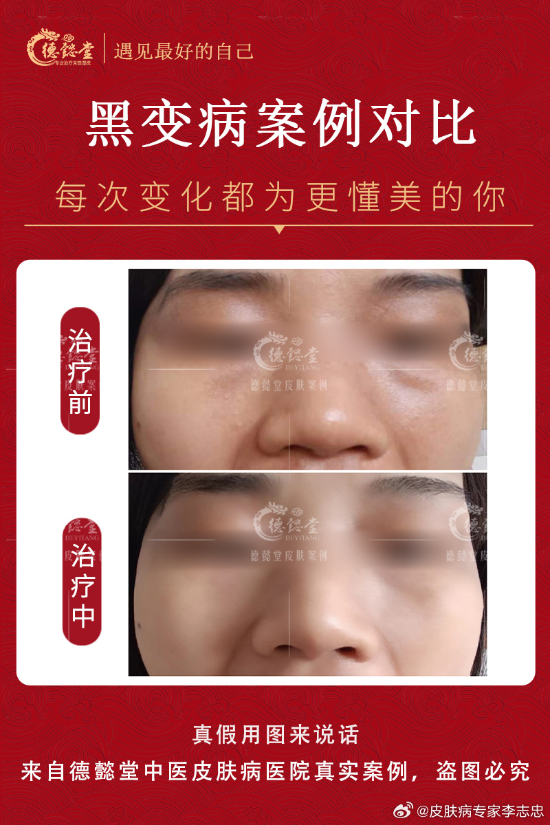 黑变病最新治疗方法研究及进展